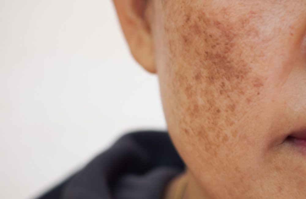 melasma-controlar
