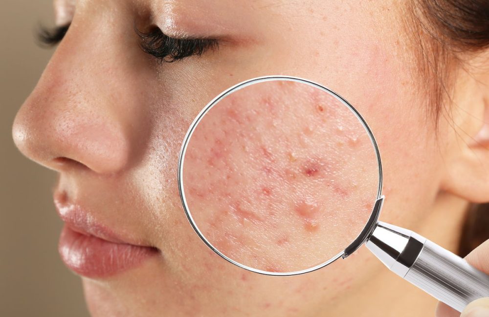 o-que-e-acne_57333